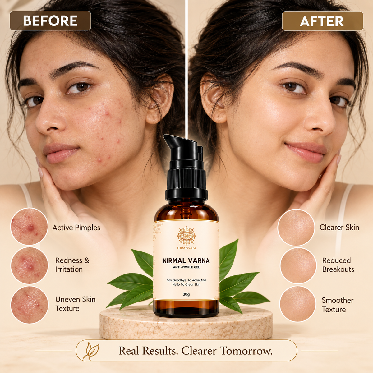 Nirmal Varna Anti-Pimple Gel bottle with before-after facial results; clearer skin with reduced pimples.